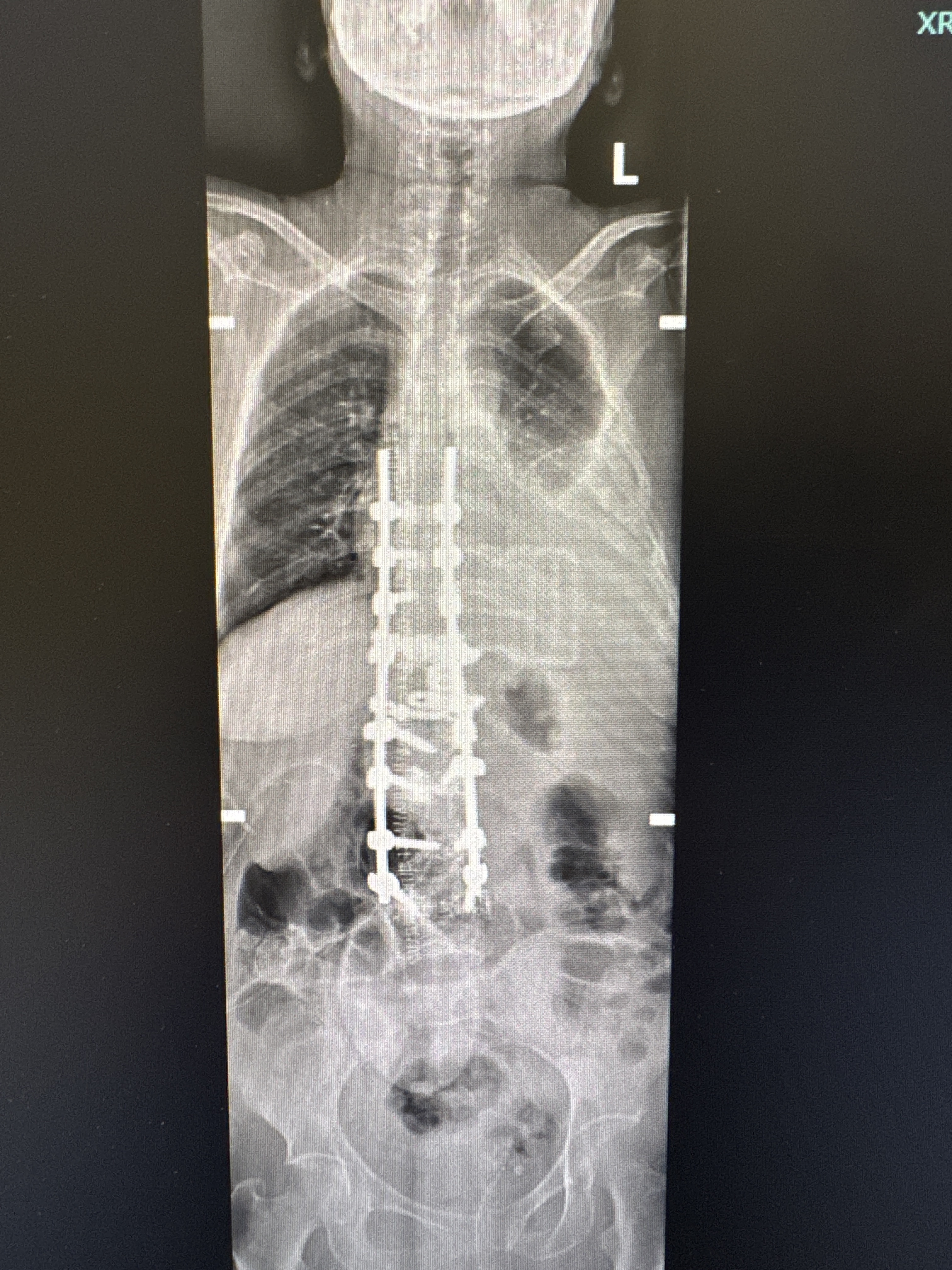 Post-operative AP X-ray showing corrected kyphosis with instrumentation
