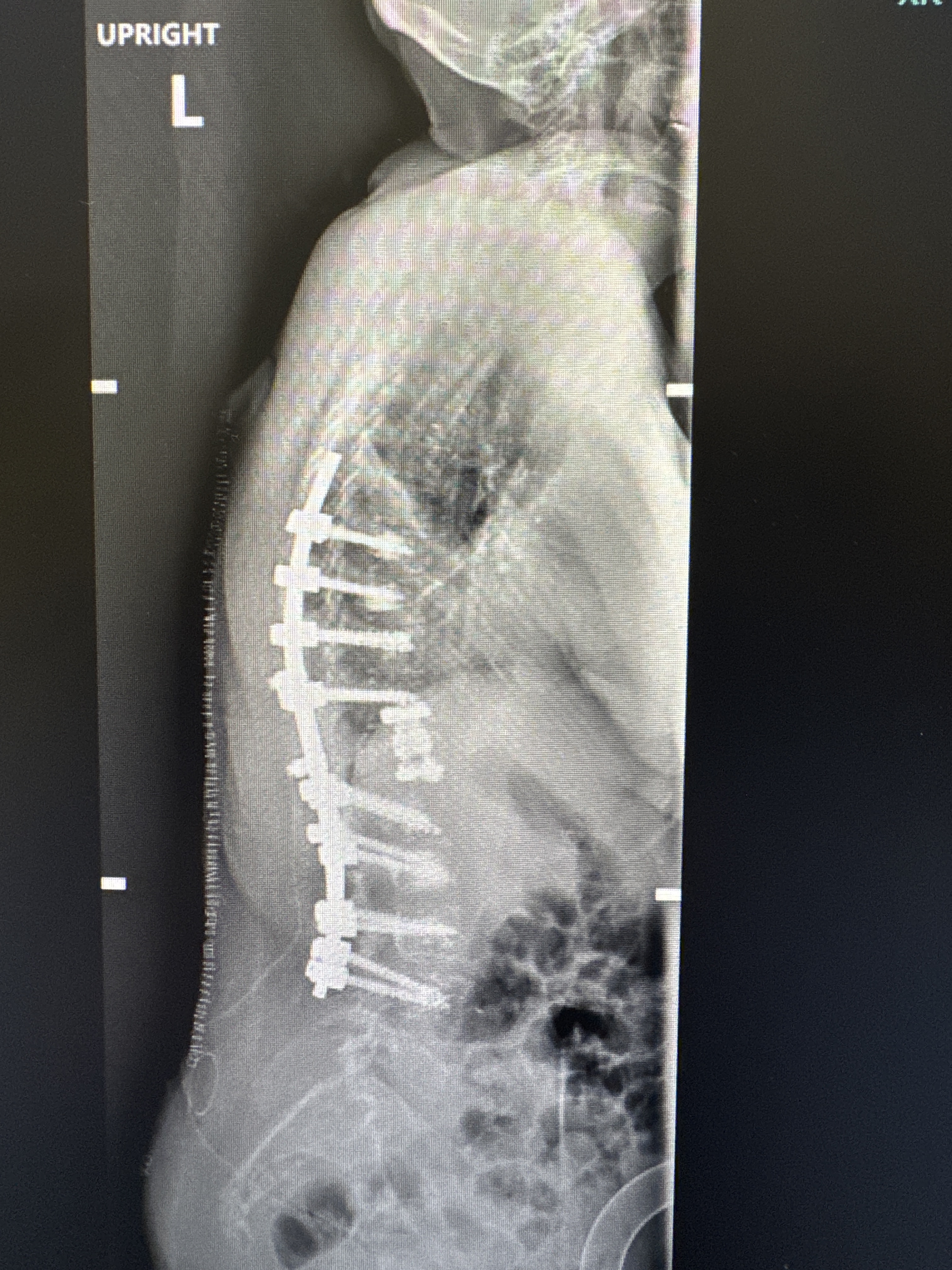 Post-operative lateral X-ray showing restored sagittal alignment
