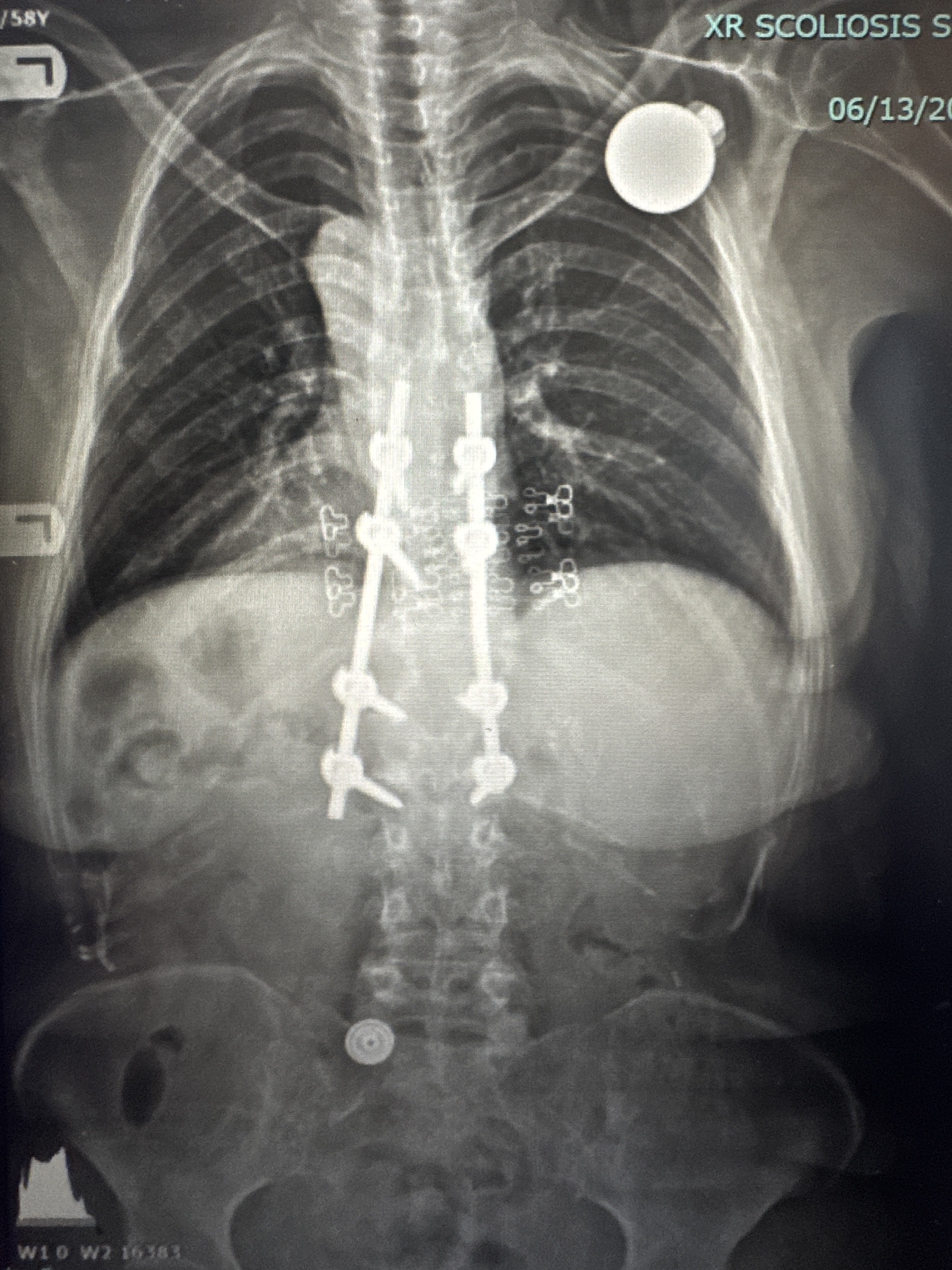 Pre-operative AP X-ray showing thoracic kyphosis deformity