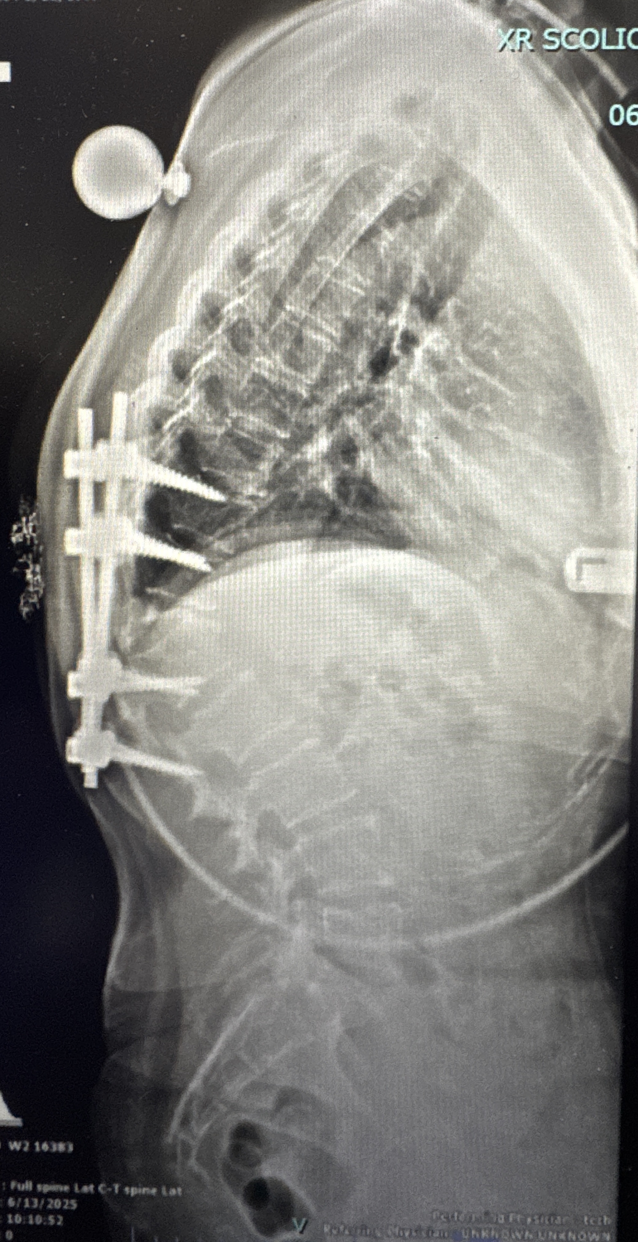 Pre-operative lateral X-ray showing kyphotic deformity