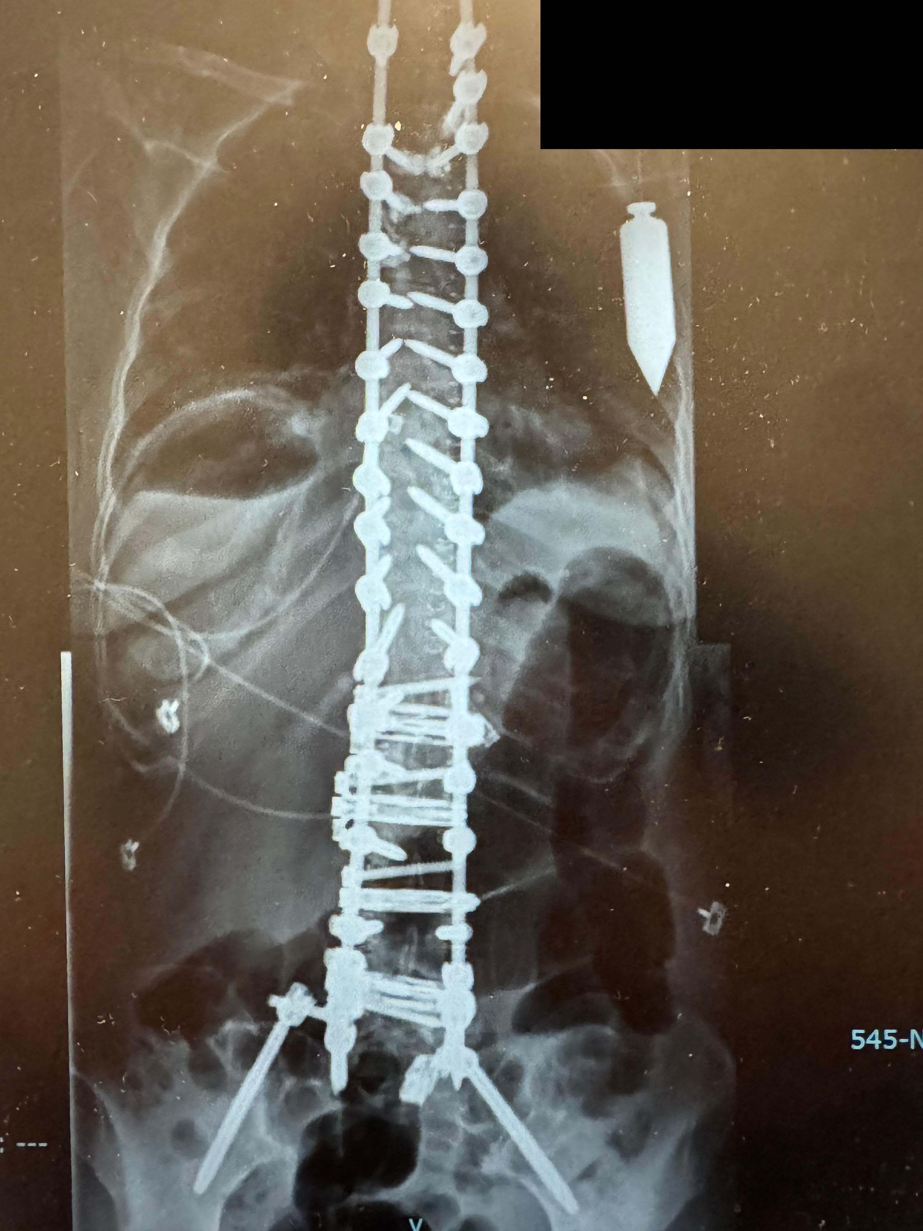 Post-operative AP X-ray showing corrected alignment with instrumentation