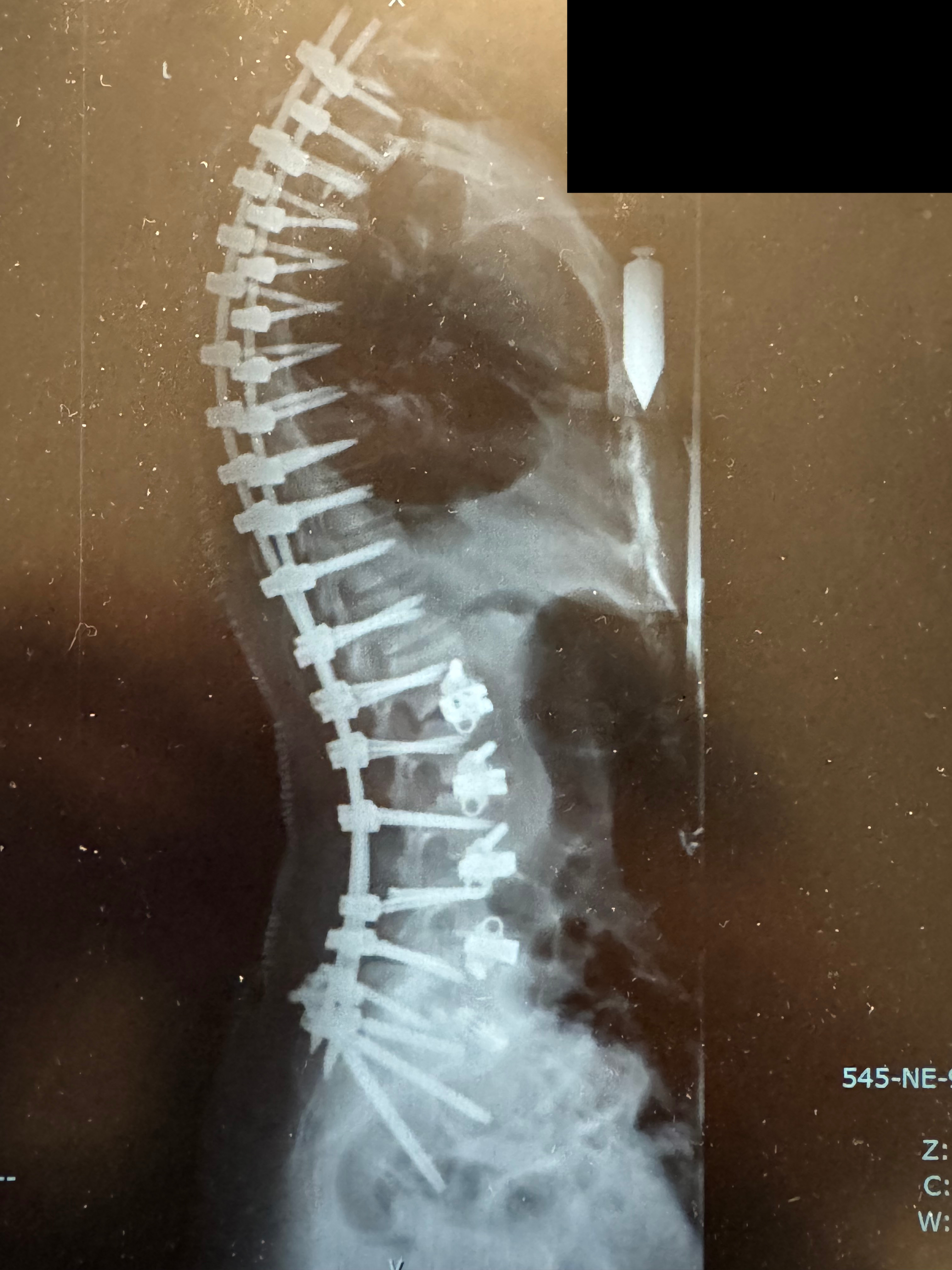 Post-operative lateral X-ray showing restored sagittal balance