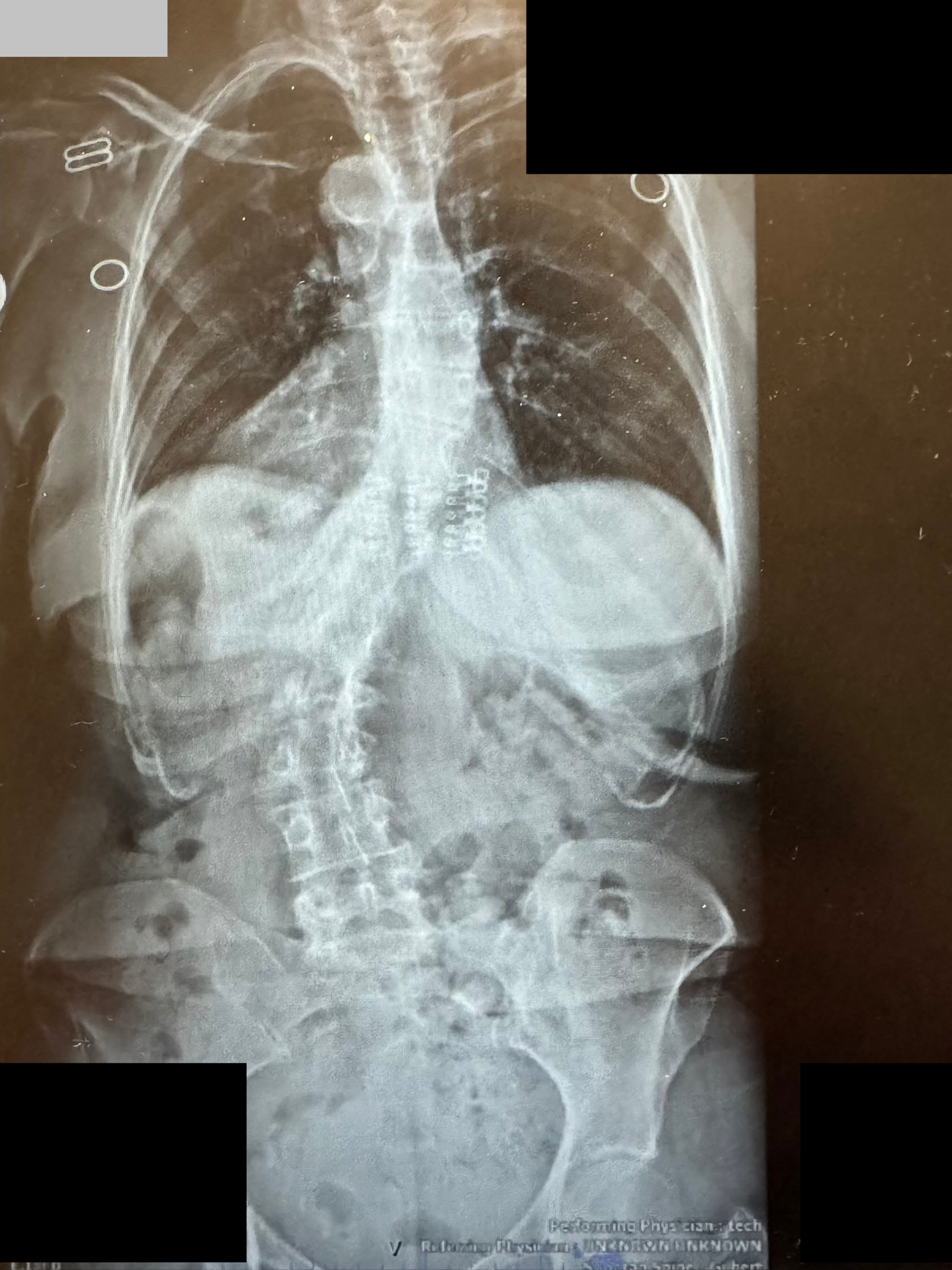 Pre-operative AP X-ray showing thoracolumbar scoliosis deformity