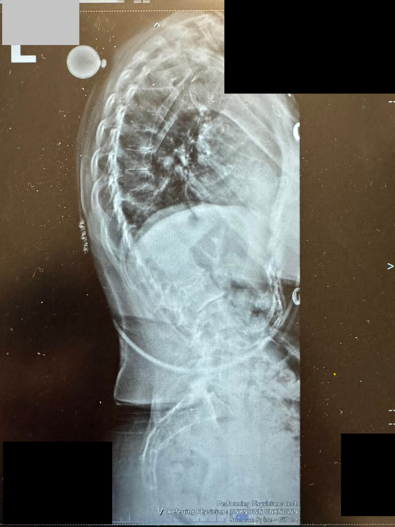 Pre-operative lateral X-ray showing excessive kyphosis