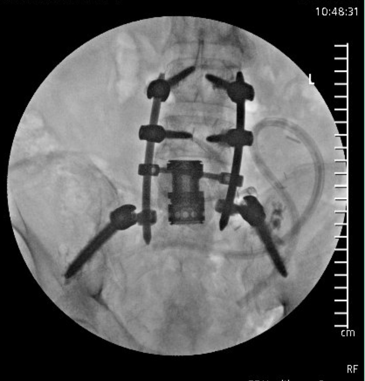 AP fluoroscopic view of instrumentation