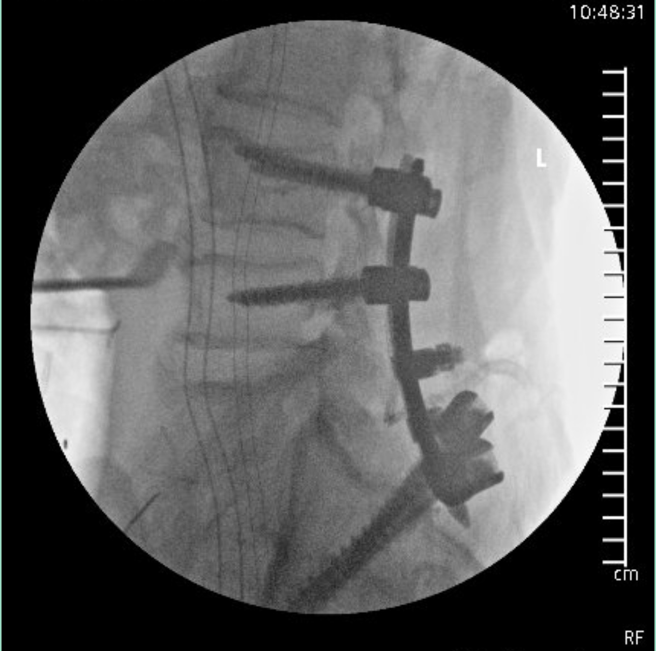 Initial intra-operative fluoroscopy