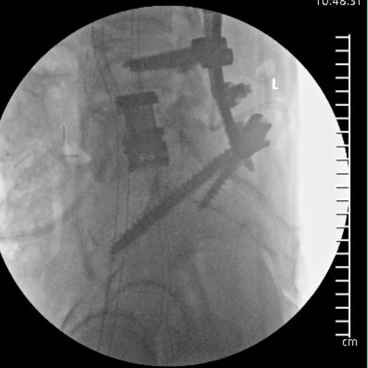 Lateral fluoroscopic view showing sagittal alignment
