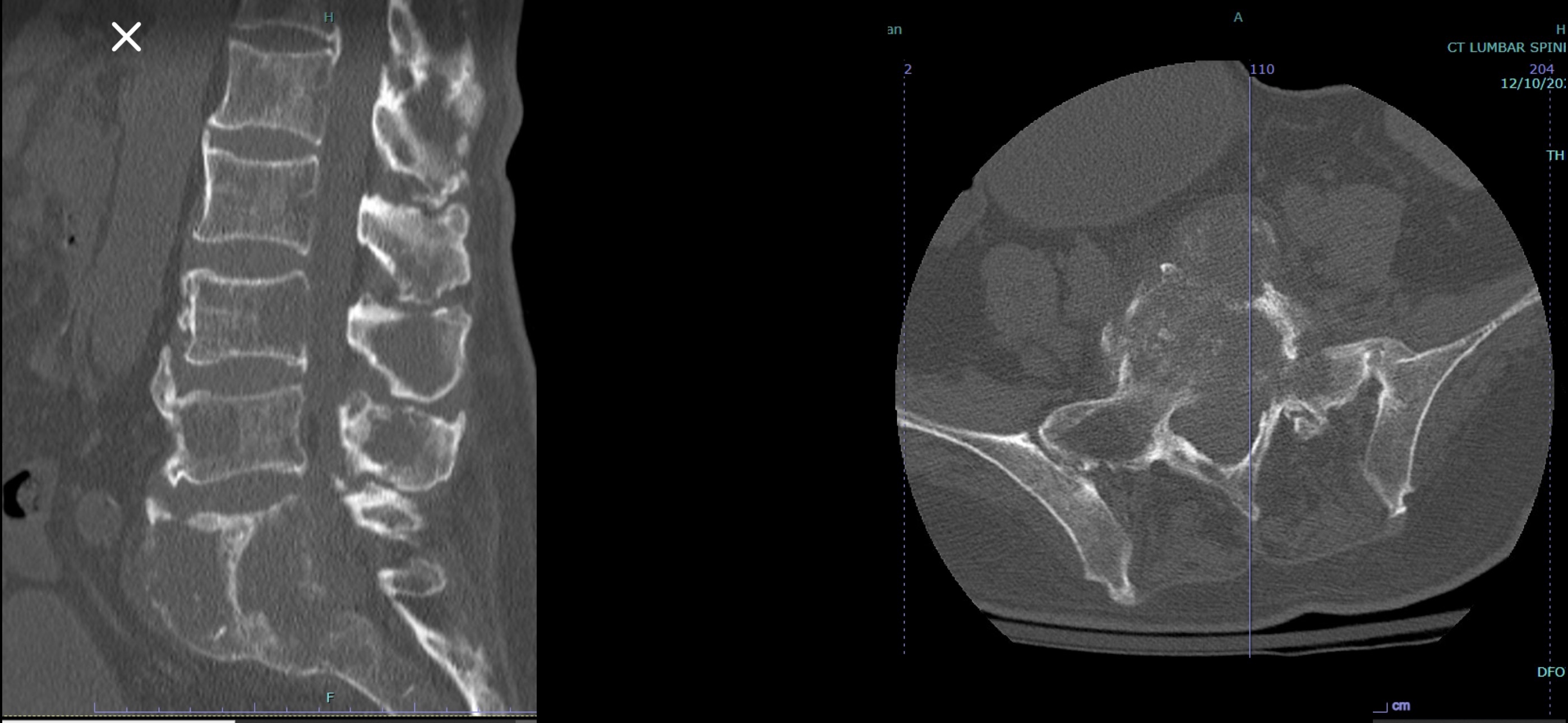 Pre-operative CT imaging showing spinal tumor