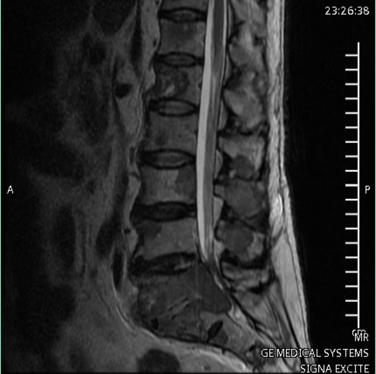 Pre-operative MRI showing spinal cord compression