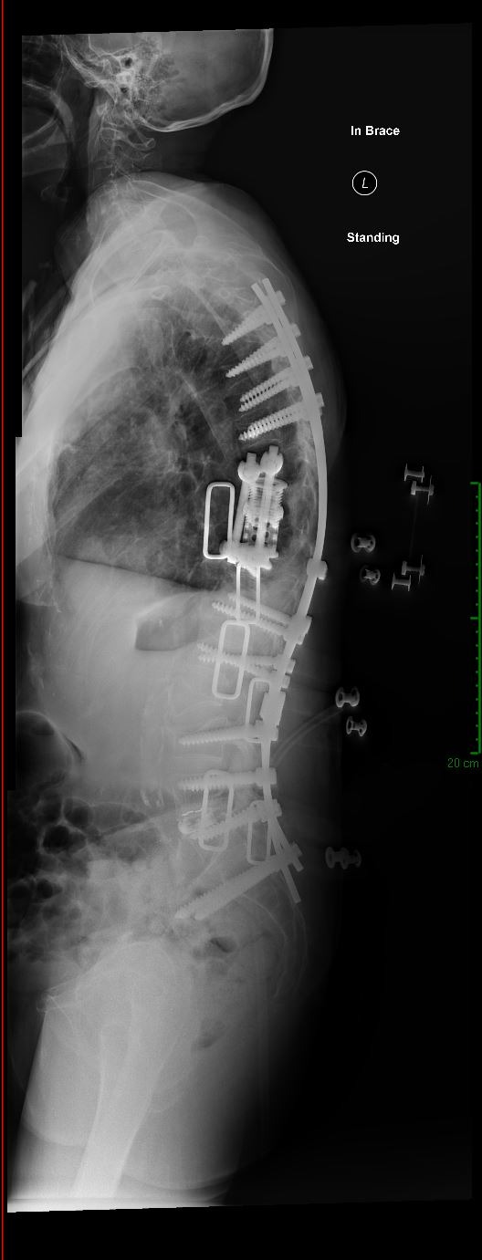 Failed back surgery with broken hardware revision — post-revision X-ray showing corrected construct