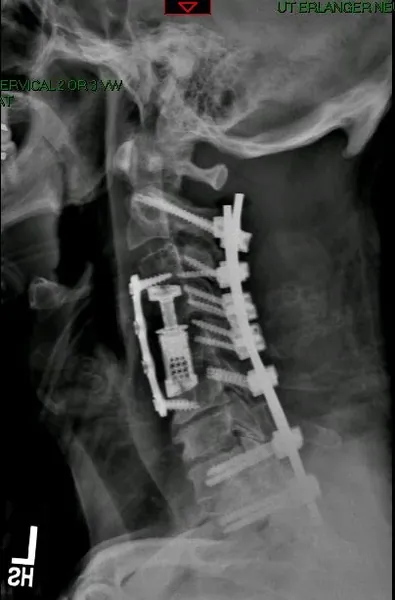 Cervical kyphosis with myelopathy — post-operative lateral X-ray showing instrumented correction