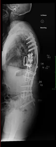 Failed back surgery — post-revision X-ray showing corrected hardware construct