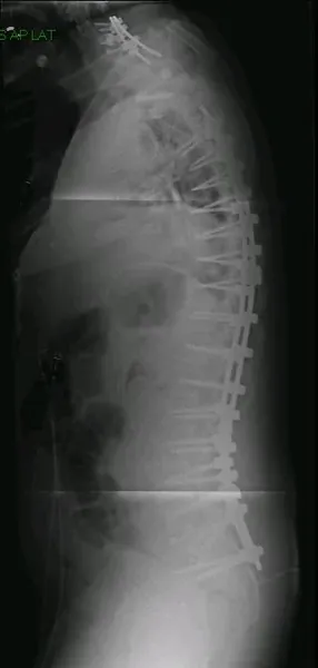 Sagittal imbalance and severe scoliosis — post-operative lateral X-ray after instrumented correction